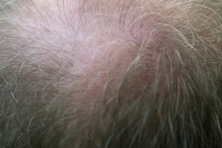 La perte de cheveux chez les hommes