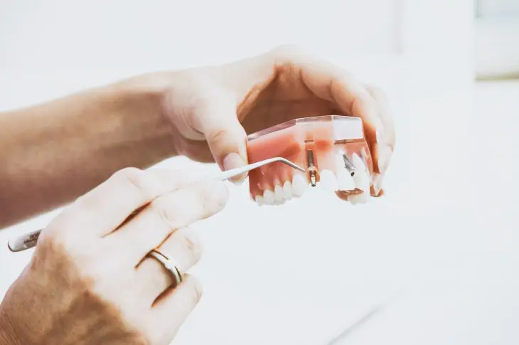 Tout sur les mini-implants dentaires